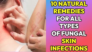 10 Natural Remedies for Fungal Infection on Skin (Tinea, Ringworm, Yeast infection, Private parts)