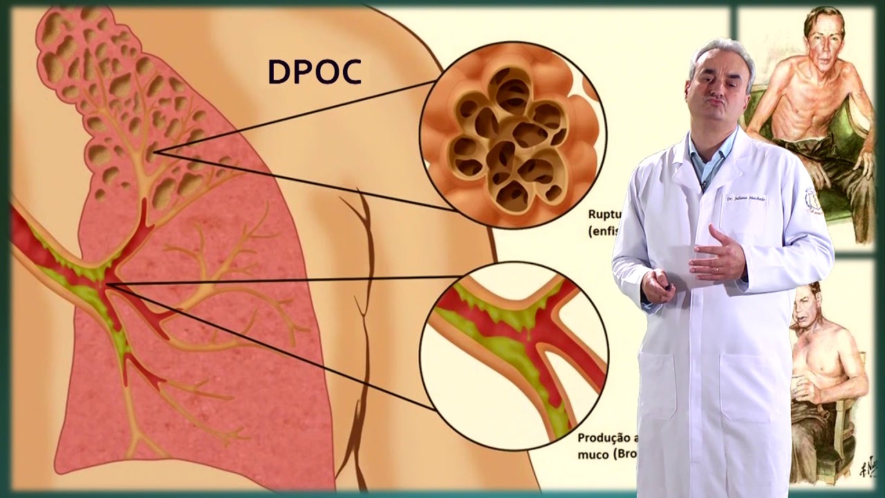 Principais síndromes pleuropulmonares | Ciclo Básico de Medicina