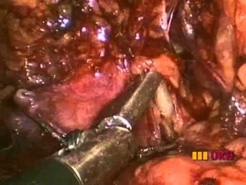 Laparoendoscopic Single-Site (LESS) Nephrectomy 