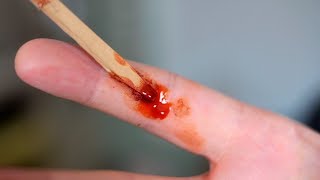 PAINFUL SPLINTER!