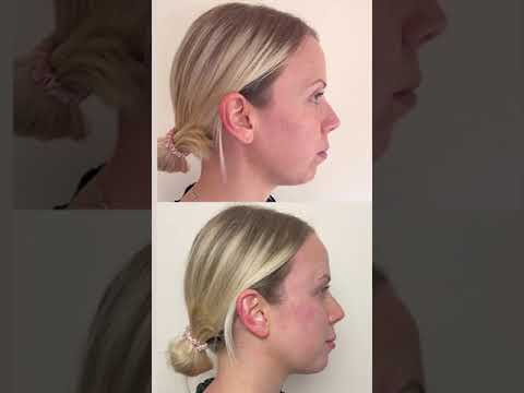 Dermal Fillers Treatment on Patient