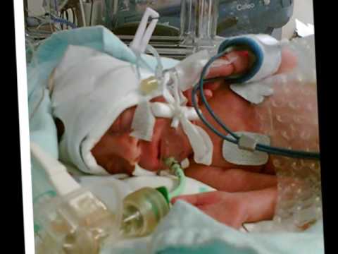 Hypoxic Ishemic Encephalopathy with Neonatal Cooling therapy _ NICU HMG