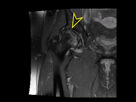 Hip MRI: Avascular Necrosis