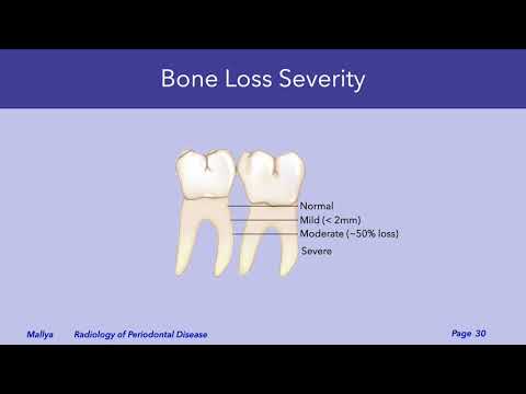 Basic Radiologic Interpretation of Periodontal Disease