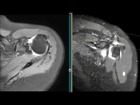 Biceps tendon high grade partial tear and subluxation