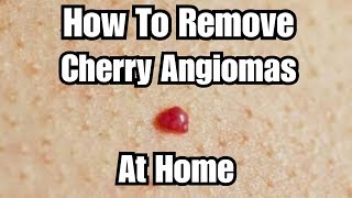 DIY Removing Cherry Angiomas at Home