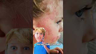 Brother&#39;s Strange Rash on face. What is it? #norrisnuts