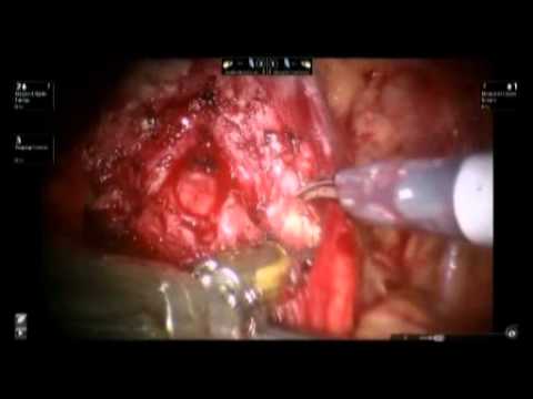 Laparoscopic Prostatectomy - The Impact Of Prostate Size