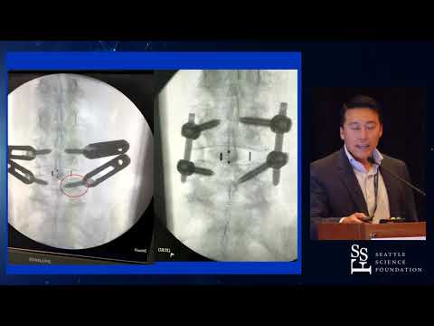 Expandable vs Static MIS TLIF Cages   Paul D  Kim, MD