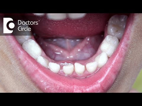 What should one do if adult permanent tooth is coming behind milk teeth? - Dr. Raju Srinivas