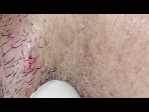 Download Mp3 Huge Ingrown Hair Gross But Satisfying Biggest