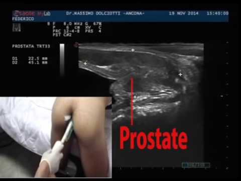 Che ha fatto lecografia della prostata Prostata prezzo litotripsia