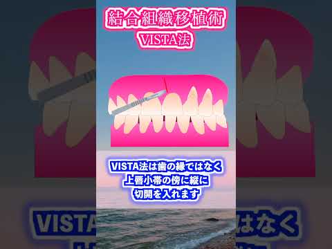 生命歯学科 歯周外科手術　結合組織移植術（VISTA法)について解説します！ #shorts  #歯周外科 ＃歯肉退縮 ＃歯を抜かない ＃歯を残す  #dentist #歯肉移植 #抜かない #歯科 #知覚過敏