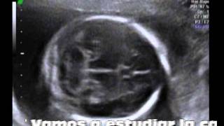 Ecograf&iacute;a 20 semanas