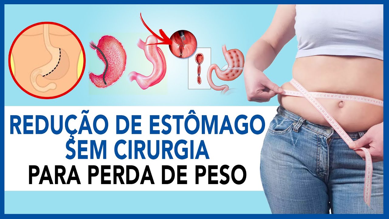 Redução de estômago sem cirurgia para perda de peso