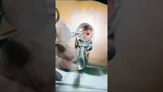Download lagu Example of IUD/spiral installation process ||#kb mp3