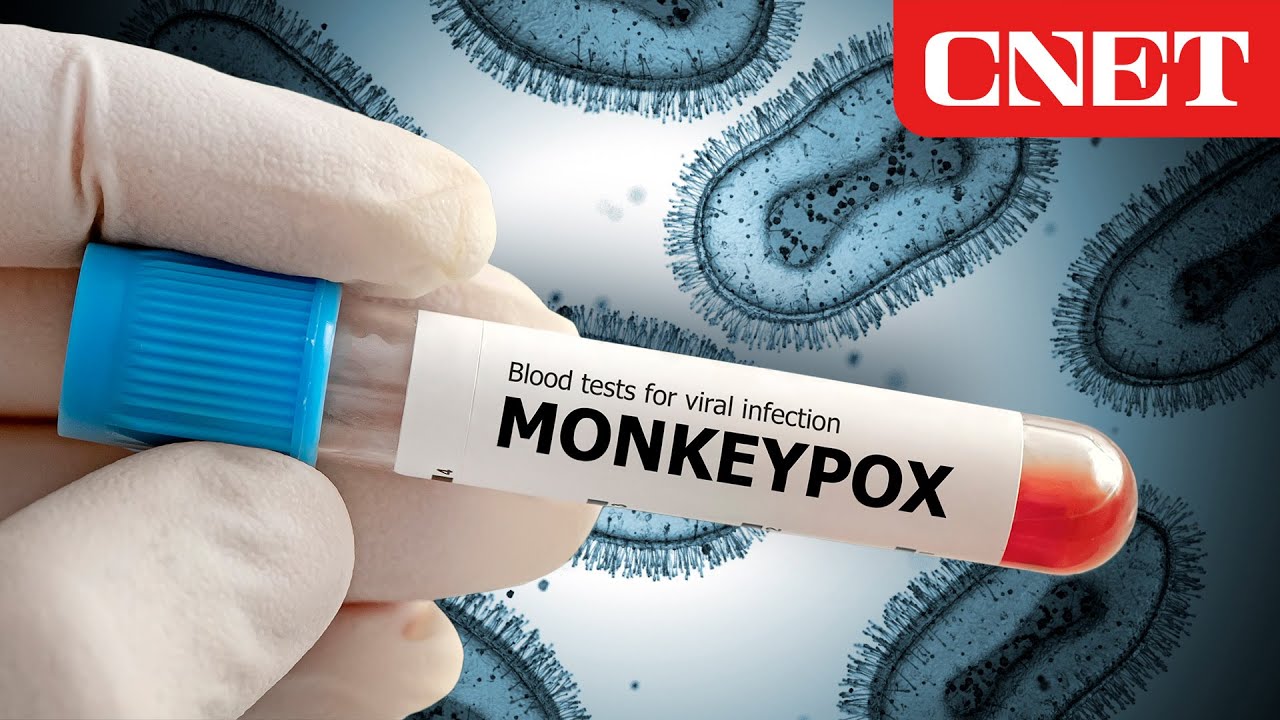 Monkeypox On The Rise: How to Stay Safe