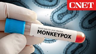 Monkeypox Explained: What You Need to Know