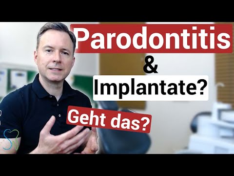 Implants and periodontitis ❗️❓🦷 | does it work❔