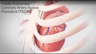Totally Endoscopic Coronary Artery Bypass Procedure (TECAB)