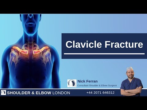 Clavicle Fracture
