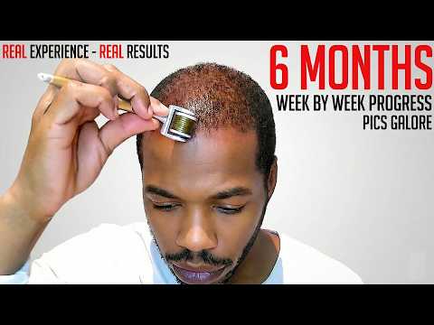 Derma Roller Hair Regrowth Results 6 Months - Month by Month Progress - Coffee as a DHT Blocker