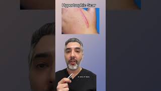 Hypertrophic vs Keloid Scars: What