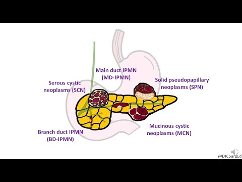 Cystic Neoplasms of Pancreas