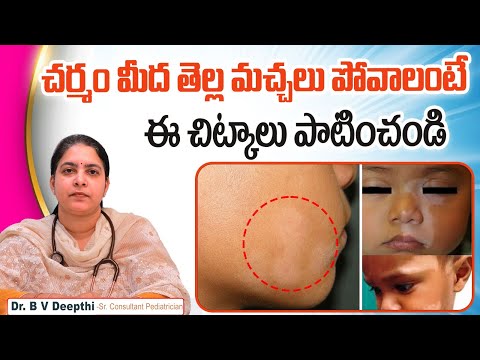 White Patches on Skin | Pityriasis Alba | Sankhya Hospital