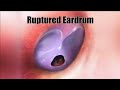 Ruptured Eardrum (Perforated Eardrum)