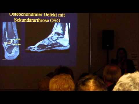 Behandlung von Osteoarthritis des Knies Klette Volksmedizin Reparieren Gelenke