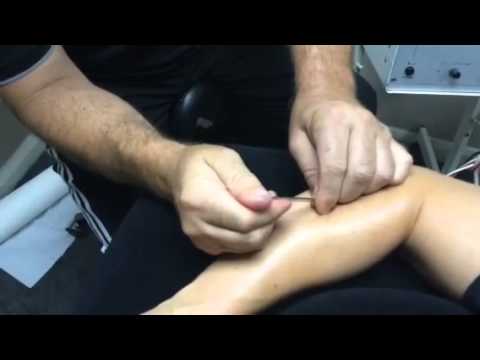Tennis elbow treatment with IMS, needling and Shockwave Therapy