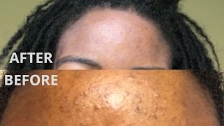 How to treat stubborn acne and get clear skin in 2 weeks | Folliculitis