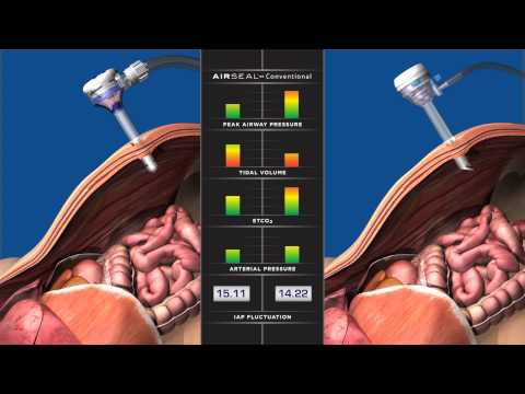 AirSeal Comparison Animation