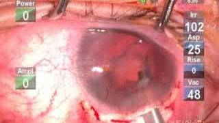 Insertion of Ophthec Artificial Iris Intraocular Lens