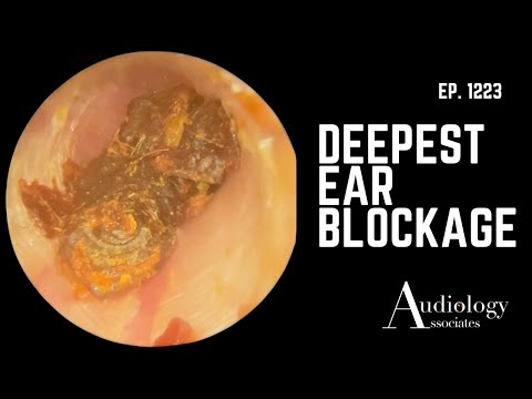 Extreme Dry Skin & Keratin Plugs Removed from the Ear Canal - EP1223