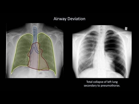 How to Interpret a Chest X-Ray (Lesson 4 - Airways, Bones, and Soft Tissues)