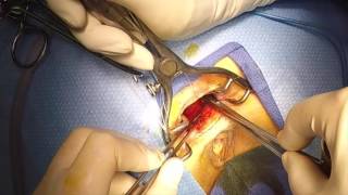 Rectocele repair Rectocele repair