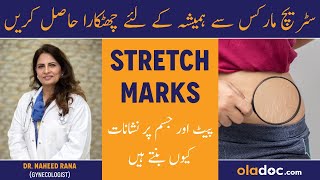 How To Remove Stretch Marks - Jism Ke Nishanat Ka Ilaj - Treatment Of Stretch Marks Kyun Hote Hain