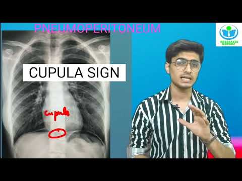 INTEGRATED SHOT#3.  PNEUMOPERITONEUM Radiology. CUPULA/ Continous Diaphragm/ RIGLER/ ligament SIGNS.