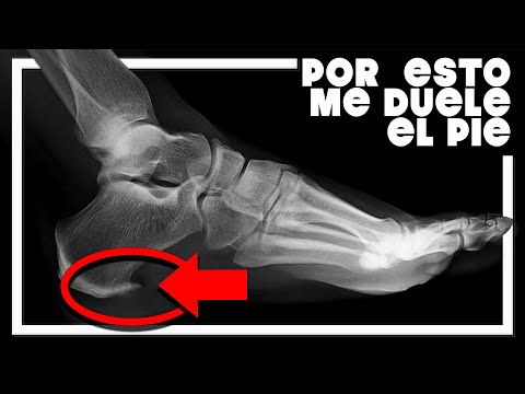 🤕 POR ESTO me MOLESTA  el PIE al CORRER 🦶...