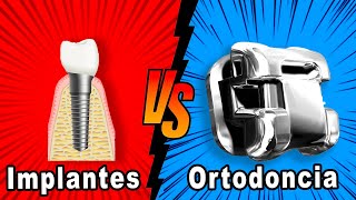 🤷‍♂️¿Se puede poner BRACKETS si llevo IMPLANTES DENTALES 🔴Ortodoncia Cuando FALTAN DIENTES