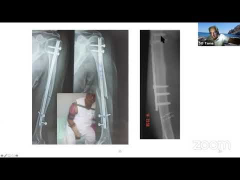 Principles of Management of Non Union Humerus Shaft Fractures DD Tanna
