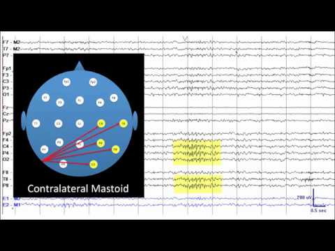 14 and 6 Hz Positive Bursts (Mini Lesson #3)