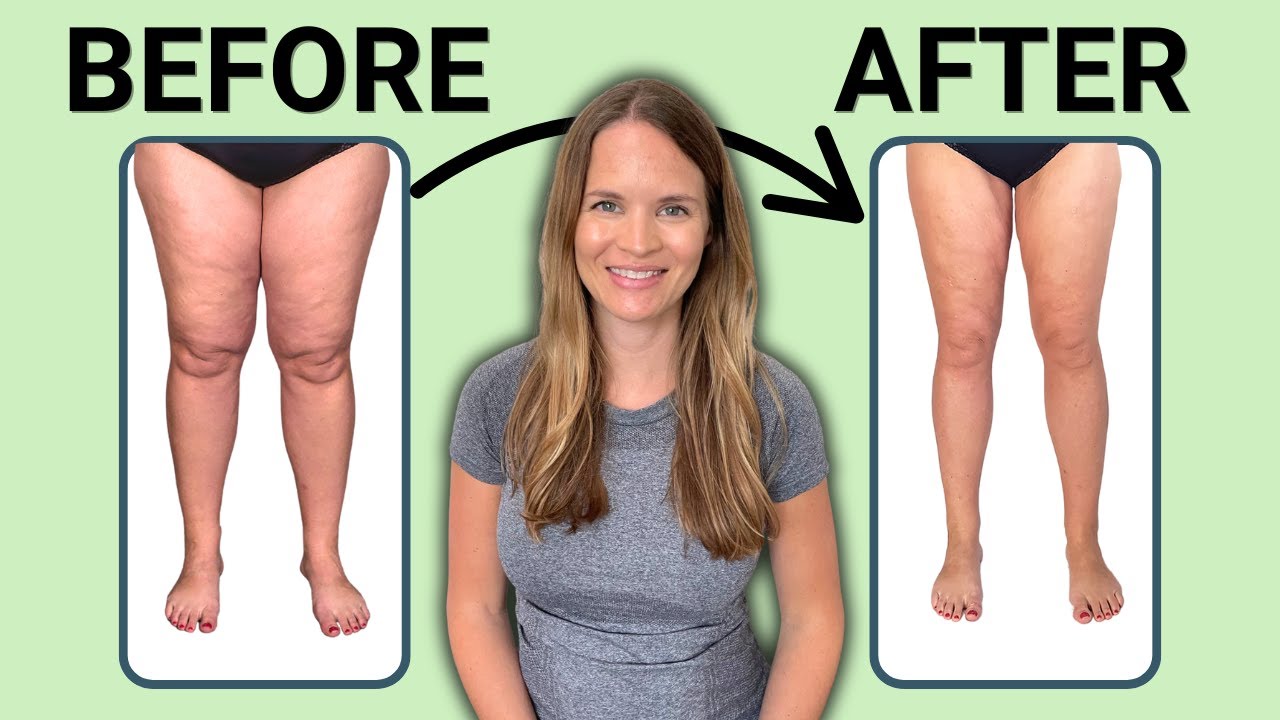 The Best Treatment for Lipedema
