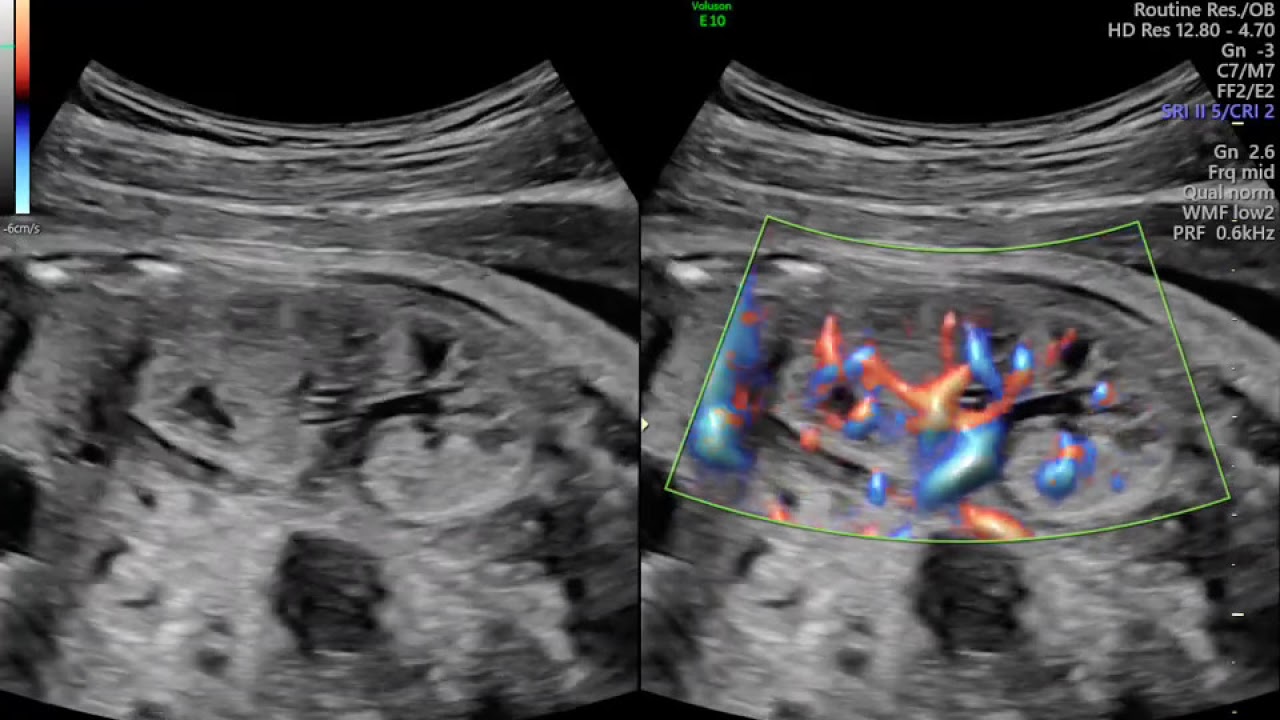 AVALIAÇÃO DO PARENQUIMA RENAL FETAL  ULTRASSON MORFOLÓGICO
