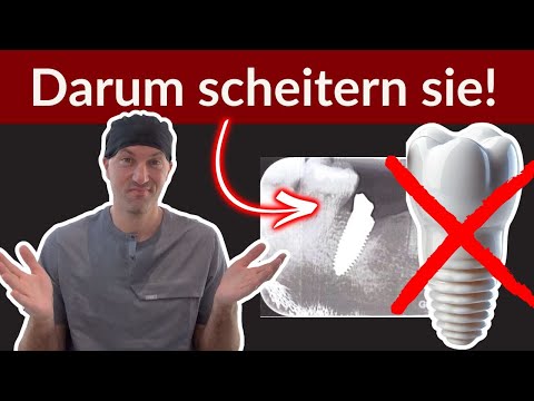 Achtung! Keramik-Implantate versagen?!? Schau Das, wenn du über Zahn-Implantate nachdenkst!