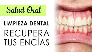 CUIDADOS DE LAS ENCÍAS DESPUÉS DE UNA LIMPIEZA DENTAL