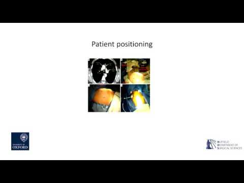 Oxford University surgical lectures: VATS thymectomy for myasthenia gravis