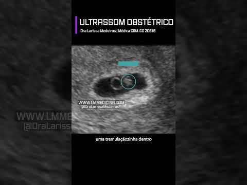 6 weeks pregnant | Obstetric ultrasound